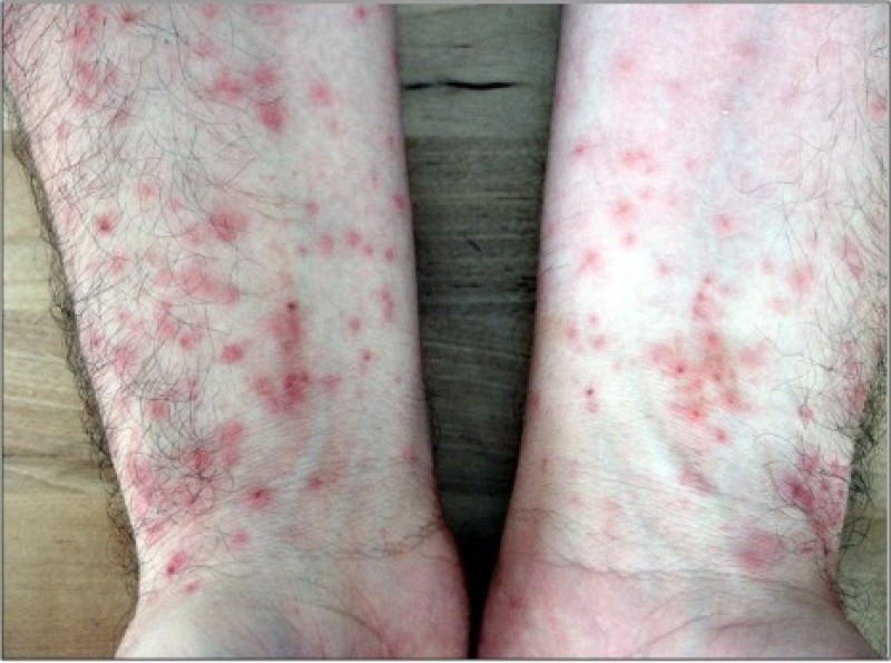 Raupenhaar-Dermatitis